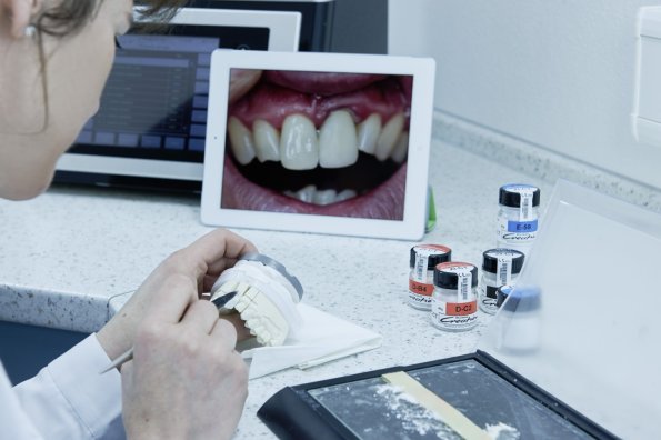 Veneers